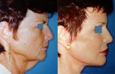before and after facial implants female patient right side view case 2638