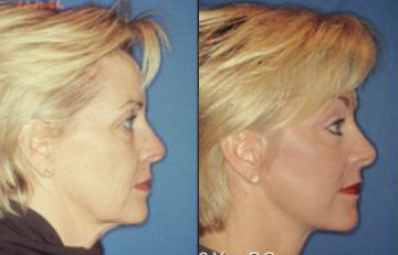 before and after laser skin resurfacing left side view female patient case 2324