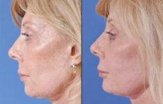 before and after laser skin resurfacing left side view female patient case 2328