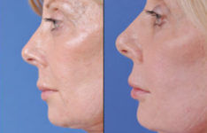 before and after laser skin resurfacing left side close up view female patient case 2328