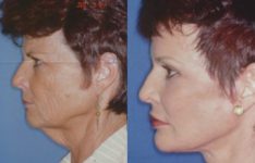 before and after laser skin resurfacing right side view female patient case 2332