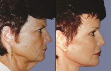 before and after laser skin resurfacing left side view female patient case 2332