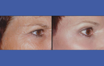 before and after laser skin resurfacing right side close up view female patient case 2332