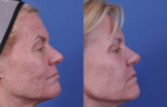 before and after laser skin resurfacing right side view female patient case 2337