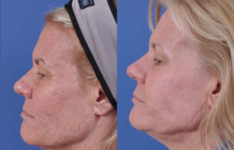 before and after laser skin resurfacing left side view female patient case 2337