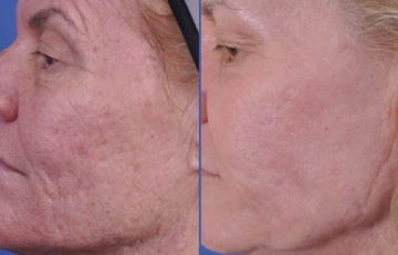 before and after laser skin resurfacing left side cheek view female patient case 2337