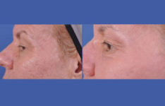 before and after laser skin resurfacing left side close up view female patient case 2337