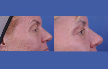 before and after laser skin resurfacing right side cheek view female patient case 2337