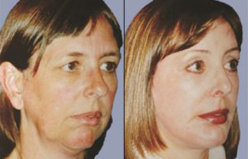 before and after laser skin resurfacing right angle view female patient case 2343