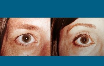 before and after laser skin resurfacing right eye view female patient case 2343
