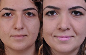before and after laser skin resurfacing front close up view female patient case 2350