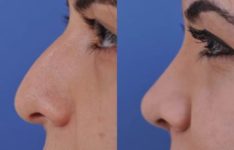 before and after laser skin resurfacing left side view female patient case 2350
