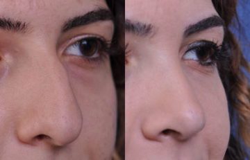 before and after laser skin resurfacing right angle view female patient case 2350