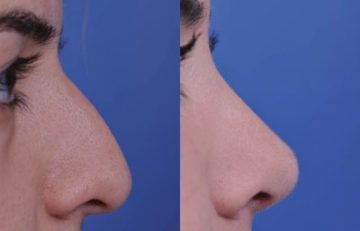 before and after laser skin resurfacing right side view female patient case 2350