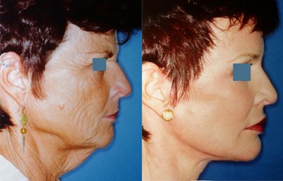 before and after neck lift female patient right side view case 2406