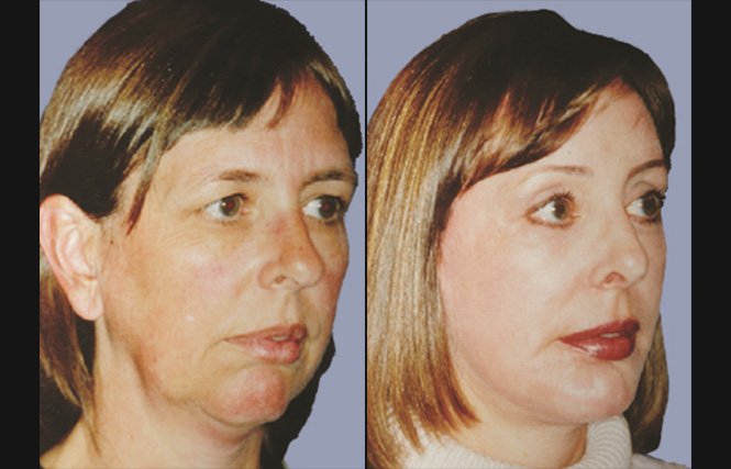 before and after neck lift female patient right angle view case 2413