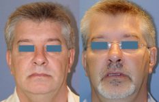 before and after neck lift male patient front view case 2425