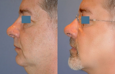 before and after neck lift male patient left side view case 2425