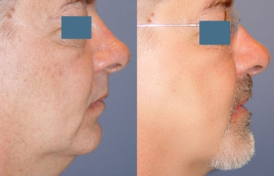 before and after neck lift male patient right side view case 2425