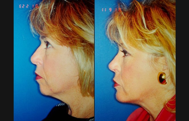 before and after neck lift female patient left side view case 2438