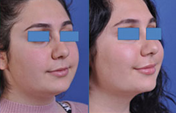 before and after neck lift female patient right angle view case 2443