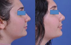 before and after neck lift female patient right side view case 2443