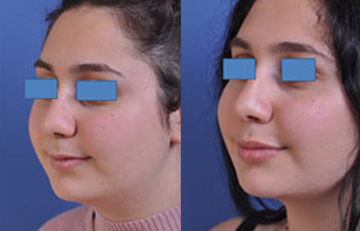 before and after neck lift female patient left angle view case 2443