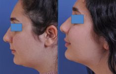 before and after neck lift female patient left side view case 2443