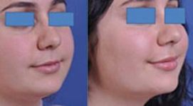 before and after neck lift female patient right angle view case 2443