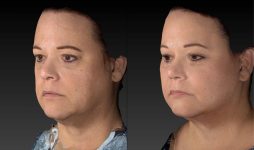before and after neck lift female patient left angle view case 3099