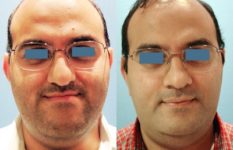 before and after orthognathic surgery male patient front view case 2525