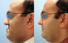 before and after orthognathic surgery male patient left side view case 2525