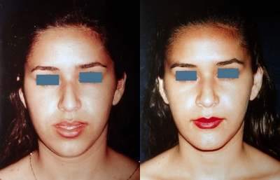 before and after orthognathic surgery female patient front view case 2528