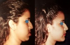 before and after orthognathic surgery female patient right side view case 2528