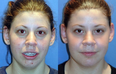 before and after orthognathic surgery female patient front view case 2531