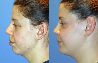 before and after orthognathic surgery female patient left side view case 2531