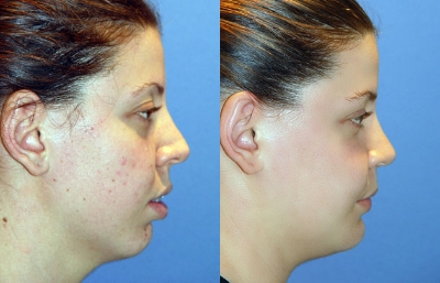 before and after orthognathic surgery female patient right side view case 2531