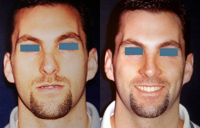 before and after orthognathic surgery male patient smiling front view case 2535