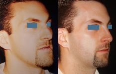 before and after orthognathic surgery male patient right angle view case 2535