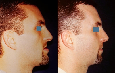 before and after orthognathic surgery male patient right side view case 2535
