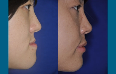 before and after orthognathic surgery right side view case 2539