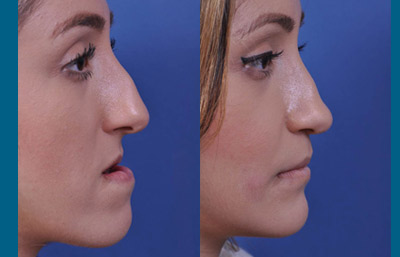 before and after orthognathic surgery female patient right side view case 2544