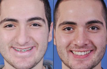 before and after orthognathic surgery male patient smiling front view case 2550
