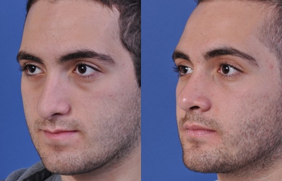 before and after orthognathic surgery male patient left angle view case 2550