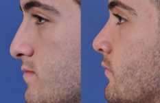 before and after orthognathic surgery male patient left side view case 2550