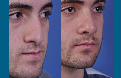 before and after orthognathic surgery male patient right angle view case 2550