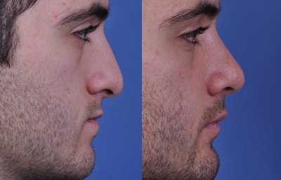 before and after orthognathic surgery male patient right side view case 2550