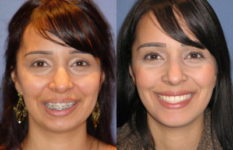 before and after orthognathic surgery female patient front view case 2556