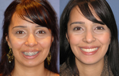 before and after orthognathic surgery female patient front view case 2556