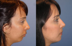 before and after orthognathic surgery female patient right side view case 2556